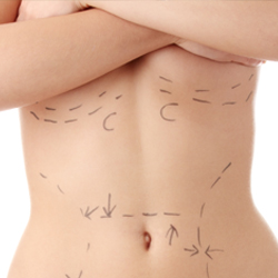 Torso of model with incision marks below breasts and on abdomen