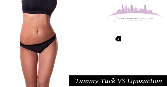 Tummy Tuck VS Liposuction