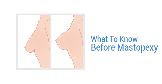 What To Know Before Mastopexy