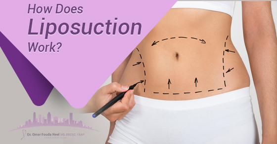 Before Liposuction Procedure