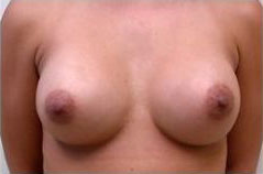 breast augmentation after
