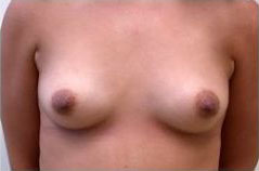 breast augmentation before