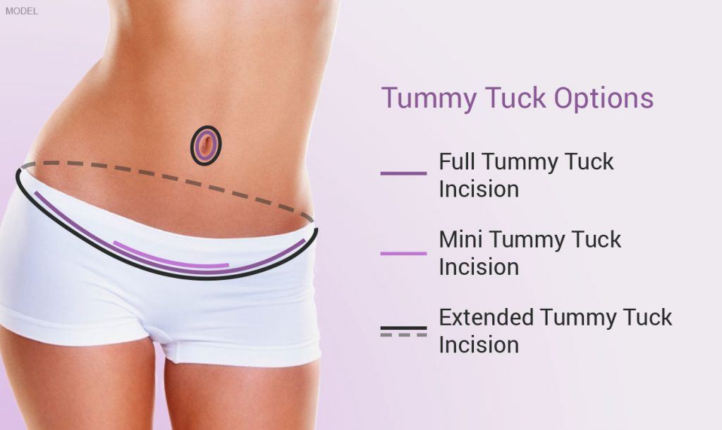 Tummy tuck incision options