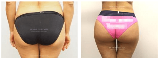 Brazilian Butt Lift vs. Traditional Butt Lift: What's the