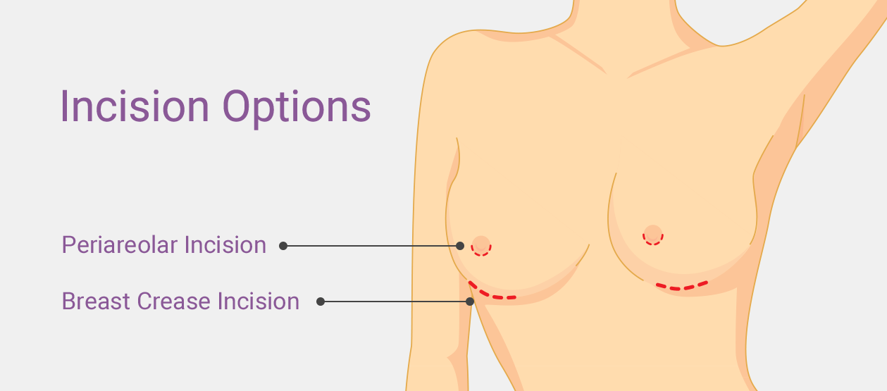 breast implant shapes