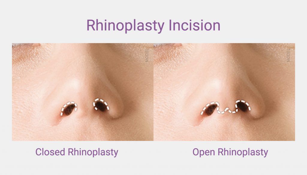 Rhinoplasty incision areas