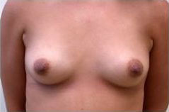 breast-aug-before