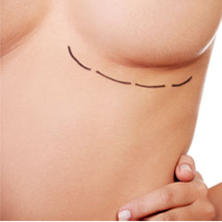 Breast Reduction Surgery Montreal