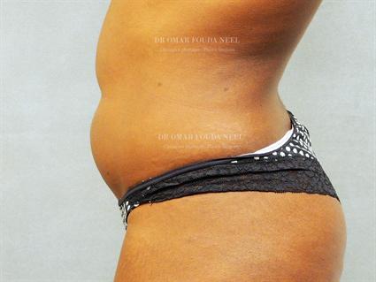 Female liposuction patient - before