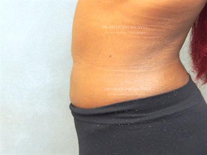 Female liposuction patient - after