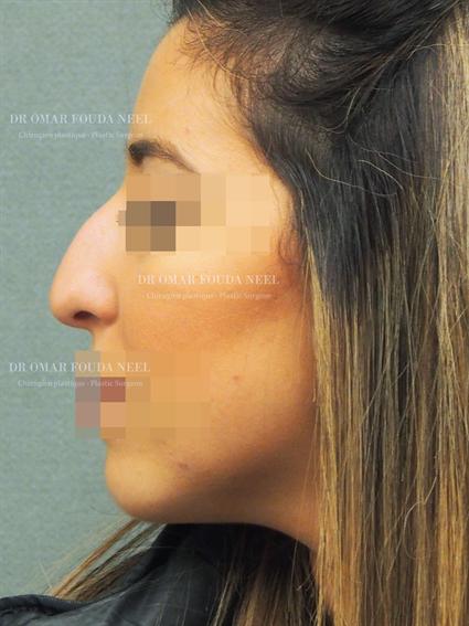 Patient's nose before rhinoplasty