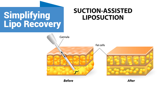 Simplifying Lipo Recovery