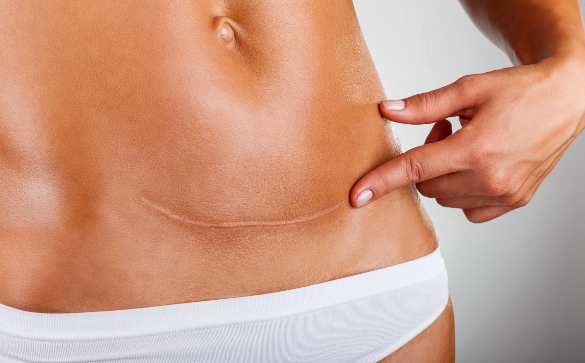 6 Ways to Reduce Tummy Tuck Scarring
