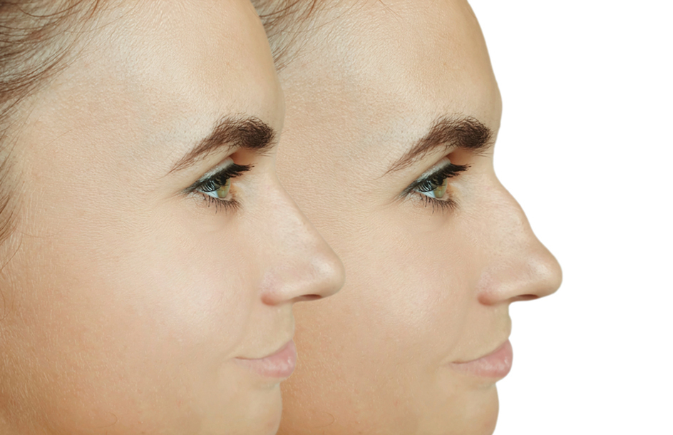 لعمليّة تجميل الأنف