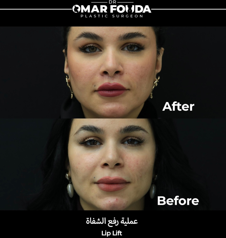 إجراء عمليّة رفع الشفة 768x811 1