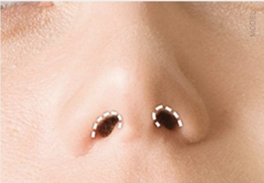 Closed Rhinoplasty