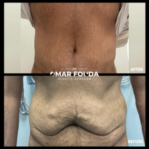 belt lipectomy